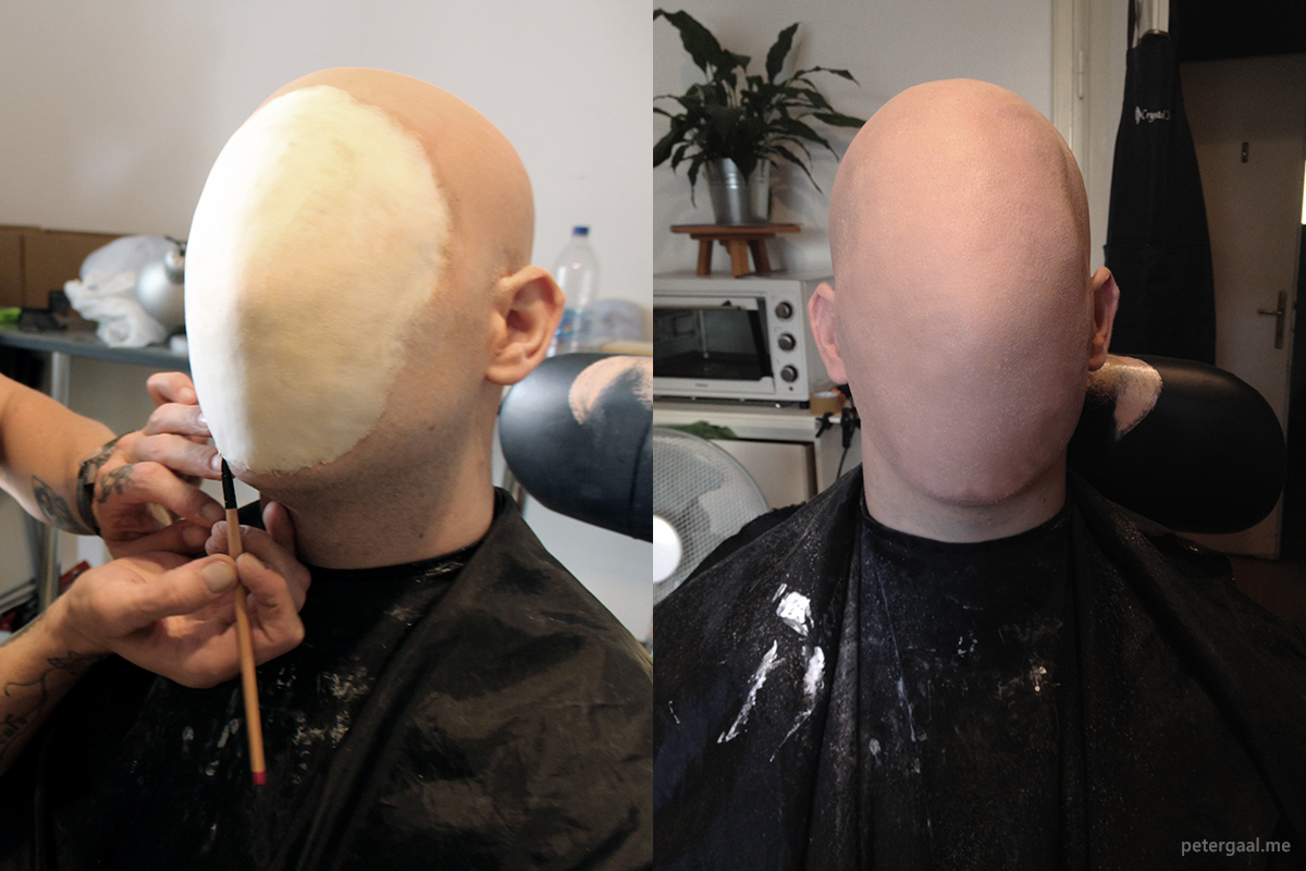 prosthetic application